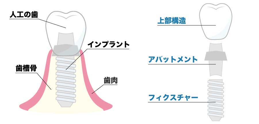 インプラントとセラミックの違いは 治療内容を知ることの大切さ 表参道デンタルクリニック インプラントとセラミックの違いは 治療内容を知ることの大切さ 表参道デンタルクリニック