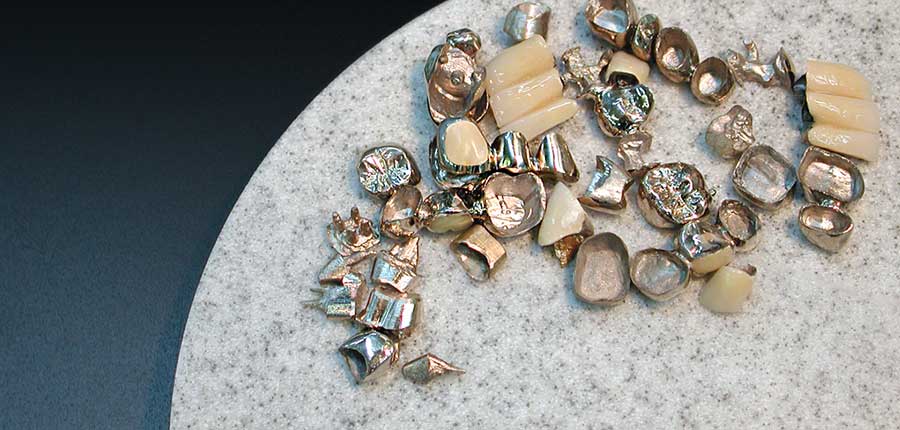 セラミックの被せ物と保険適用の銀歯 Cad Cam冠の違いを解説 表参道デンタルクリニック