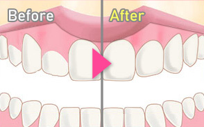 歯肉切除術・歯肉整形術・歯冠延長術