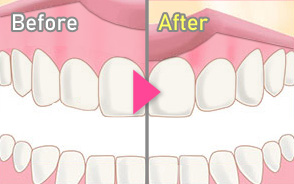 ボトックス注射