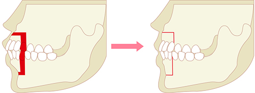 外科矯正（骨格性の治療）