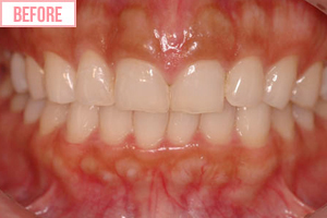 歯ぐきのライン調整(片側)施術前