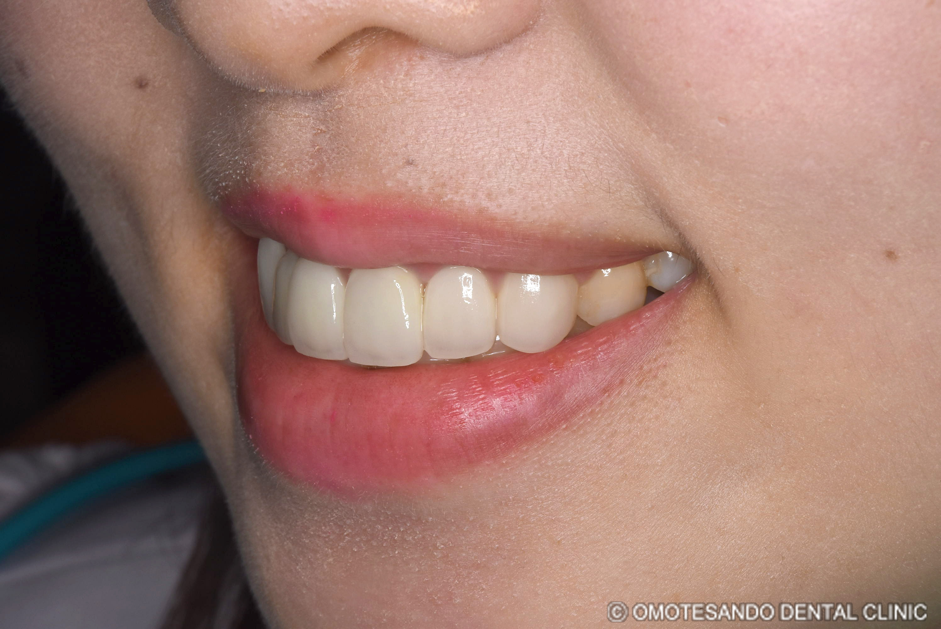 ガミースマイルアクトレス矯正30代女性_斜め_after