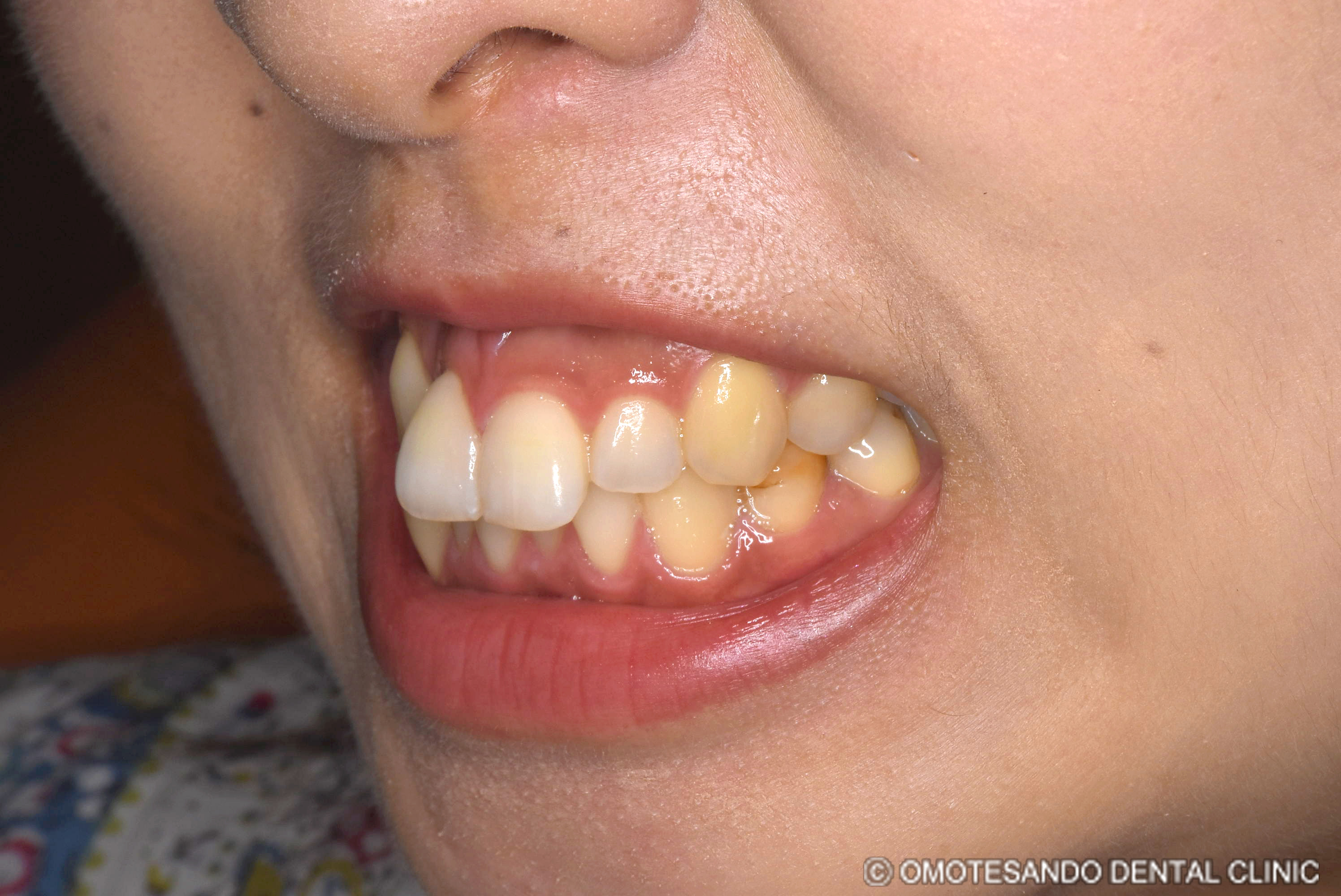 ガミースマイルアクトレス矯正30代女性_斜め_before