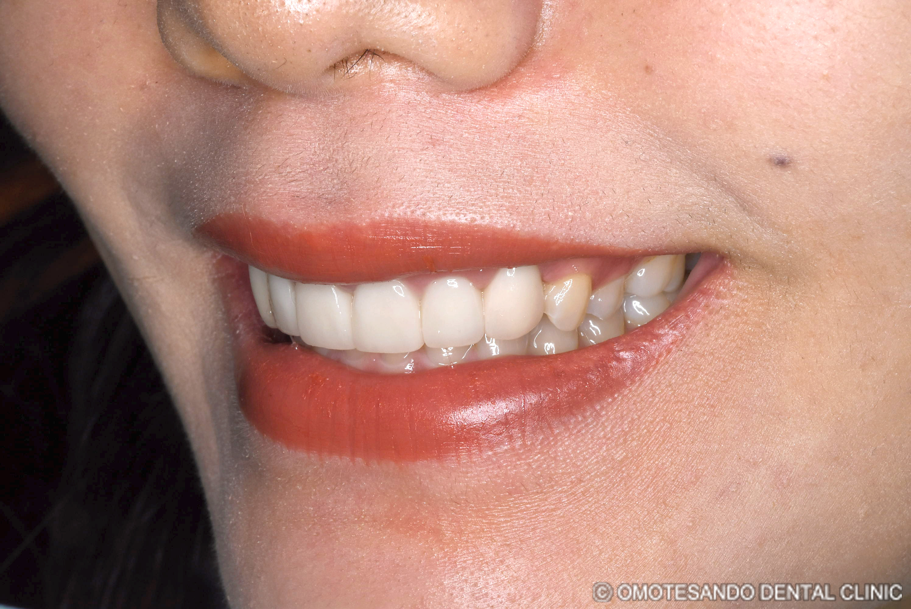 ガミースマイルセラミック矯正20代女性_斜め_after