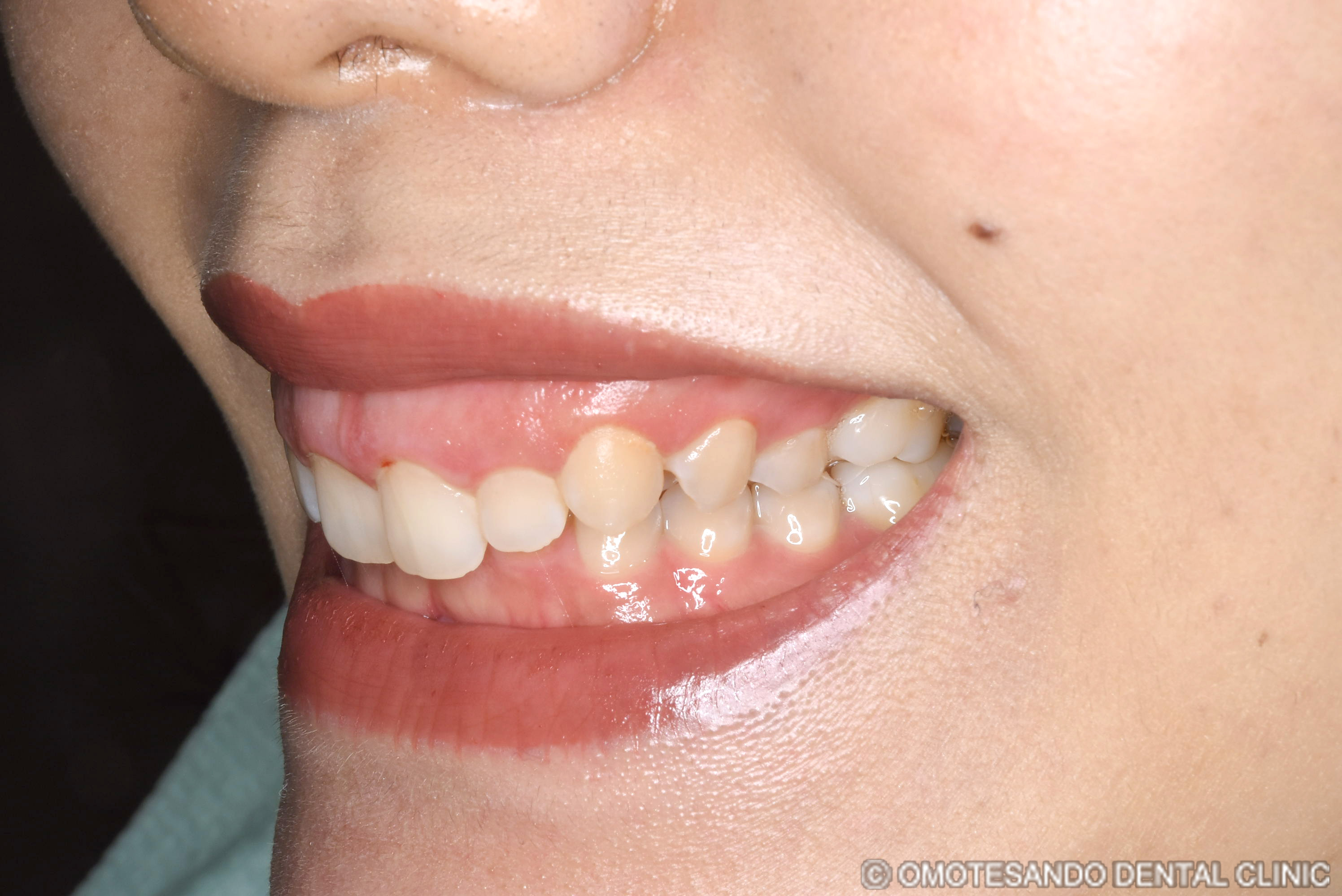ガミースマイルセラミック矯正20代女性_斜め_before