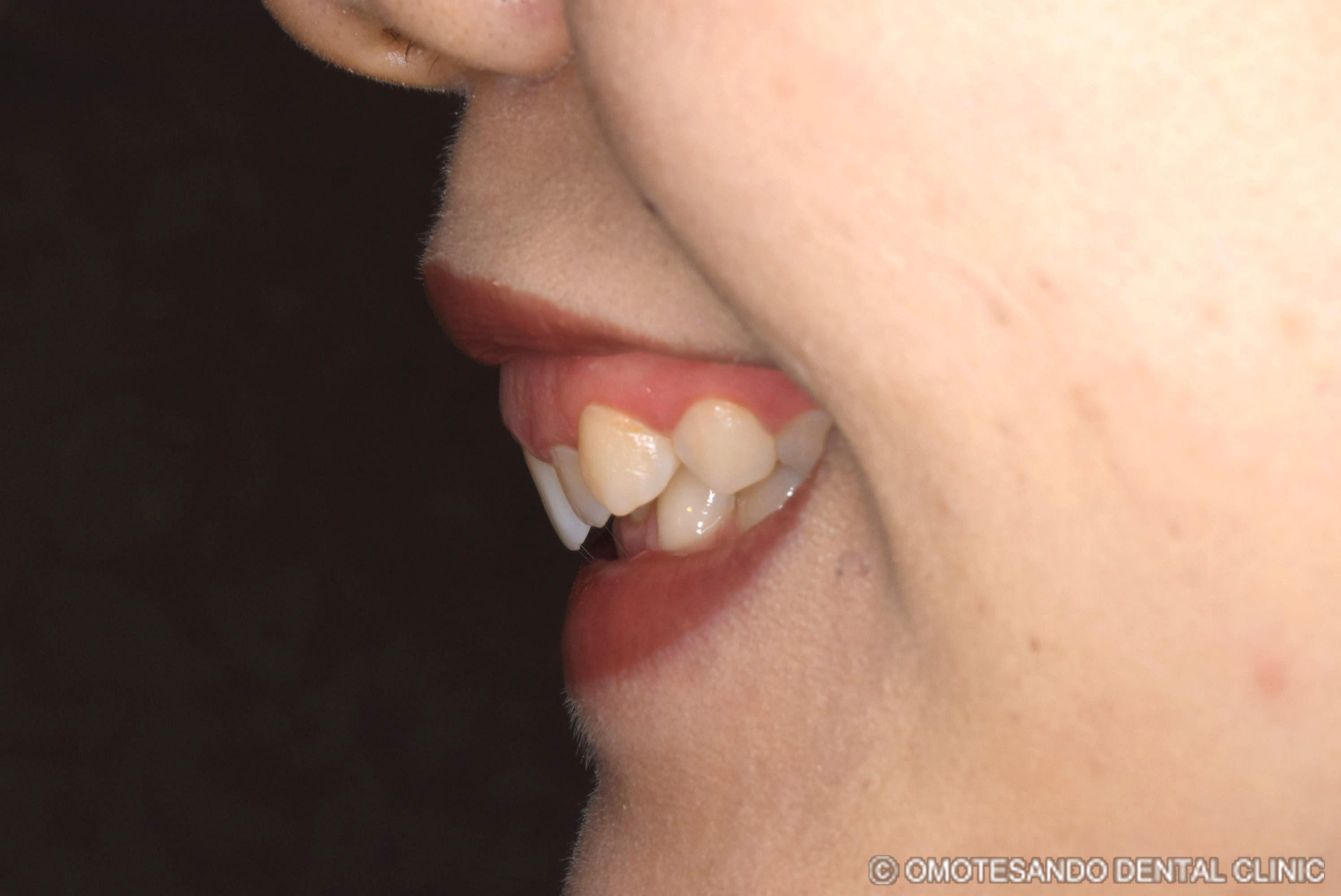 ガミースマイルセラミック矯正20代女性_サイド_before