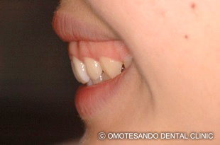 ガミースマイルワイヤー矯正（圧下矯正）20代女性_サイド_before