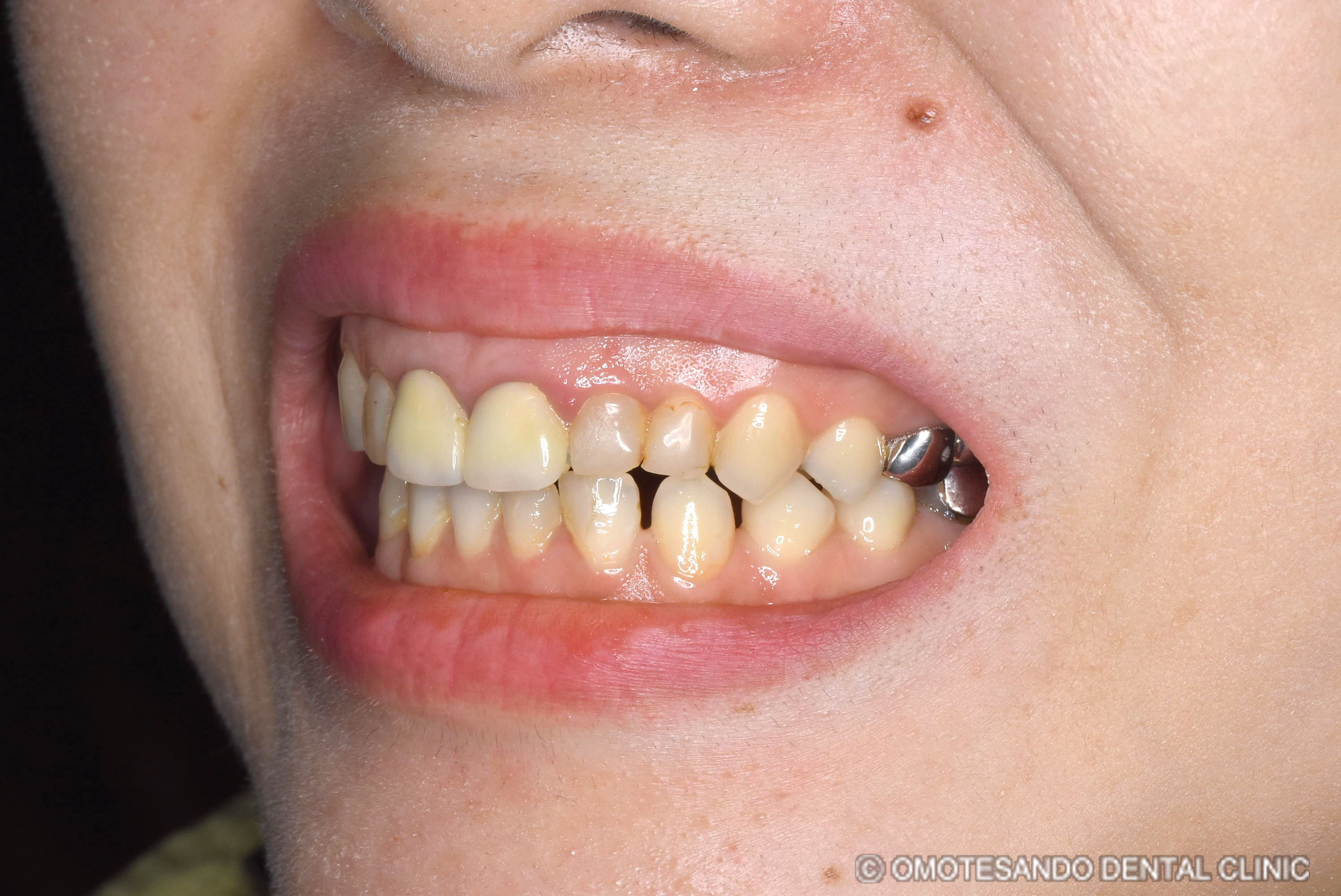 ガミースマイルワイヤー矯正＋セラミック矯正30代女性_斜め_before