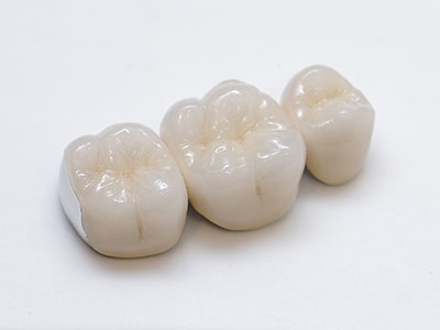 メタルボンドセラミック歯