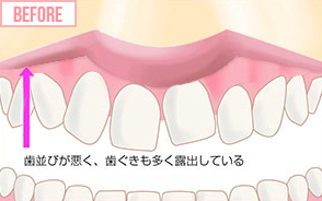 歯並びが悪く、歯茎も多く露出している