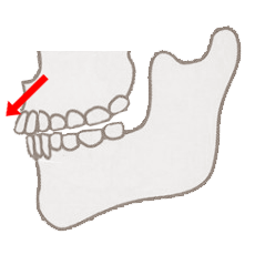 歯の向きによる出っ歯