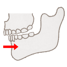 骨の位置による出っ歯