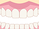 歯ぐきの整形(ガミースマイルの改善)